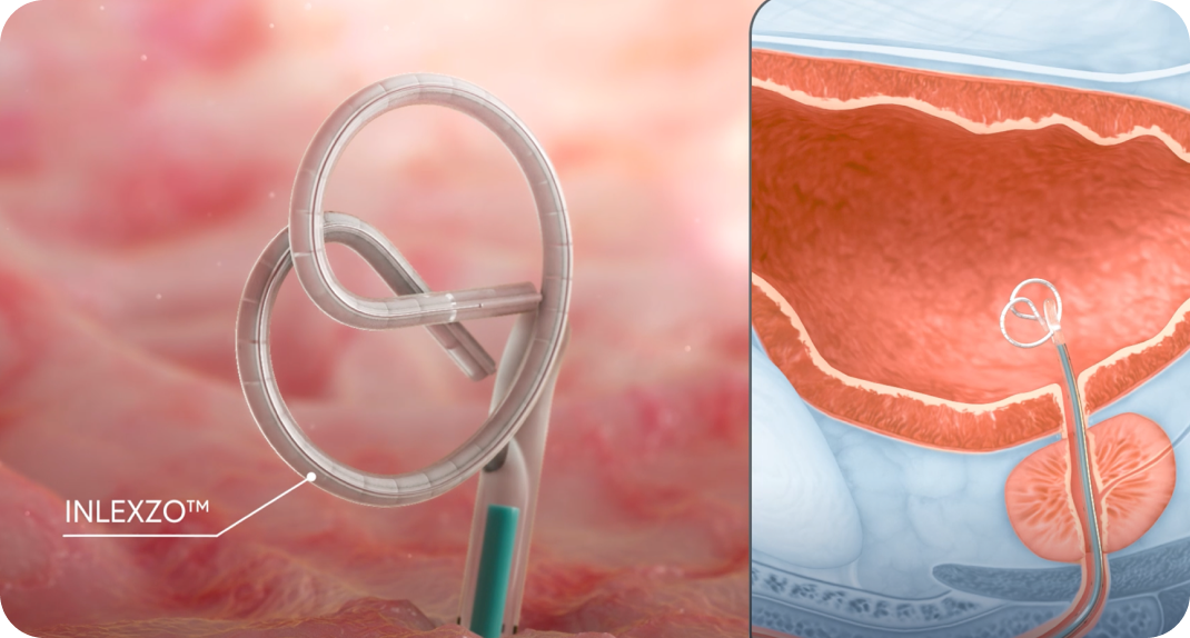 Illustration showing INLEXZO deploying from a catheter on the left, and its placement inside the bladder on the right.