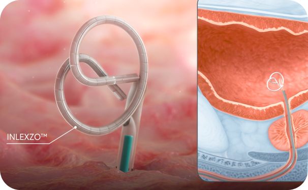 Illustration showing INLEXZO deploying from a catheter on the left, and its placement inside the bladder on the right.